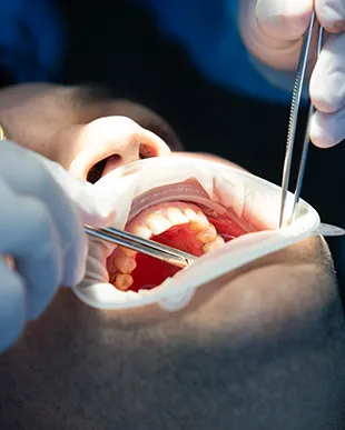 Cirurgia Oral 2