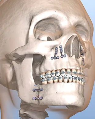 Cirurgia Ortognatica