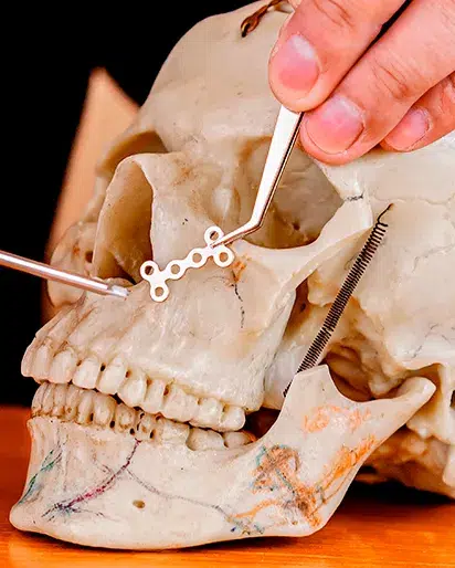Cirurgia das fraturas da face