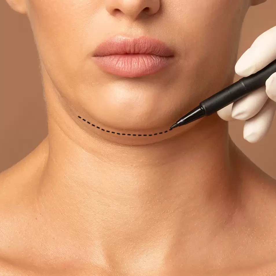 Lipo de papada 1 uai