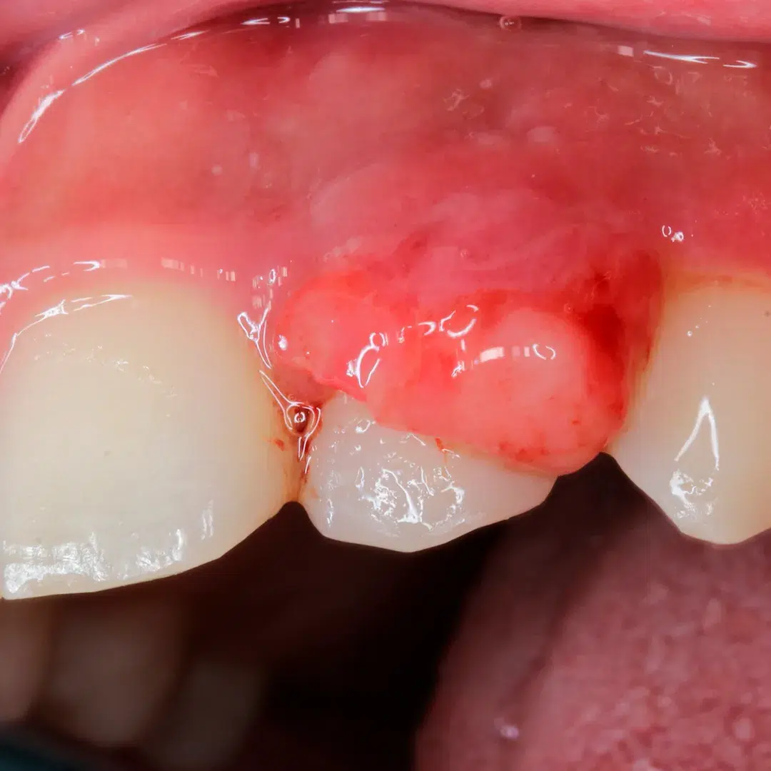 Tumor no dente